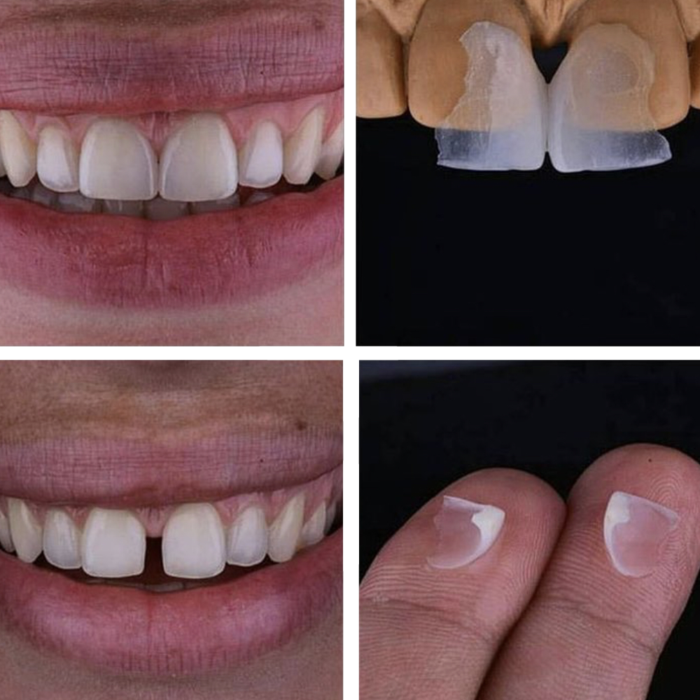 Faccette Dentali Sorridi, adesso puoi! Studio dentistico De Luca Cassandro Faccette Dentali Sorridi, adesso puoi! Studio dentistico De Luca Cassandro